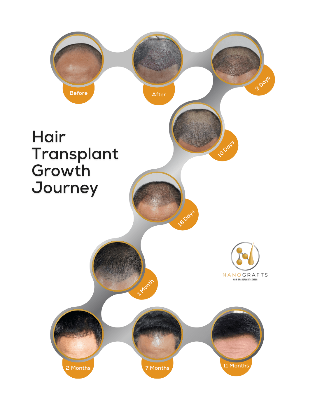 Hair Transplant Growth Journey